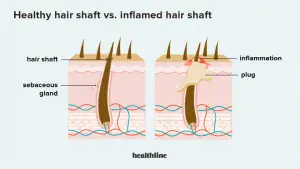 Blocked Follicle